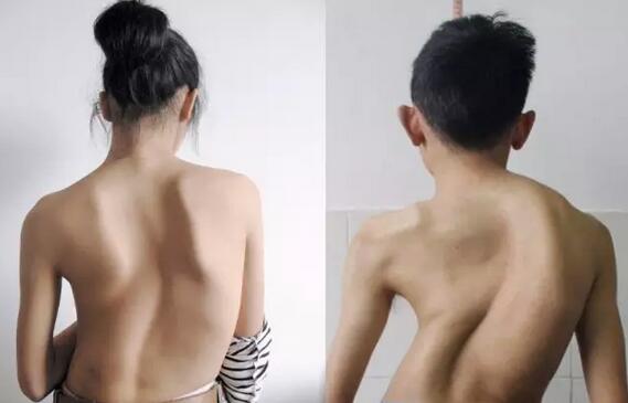 案例l3D打印支具助力青少年脊柱侧弯保守治疗