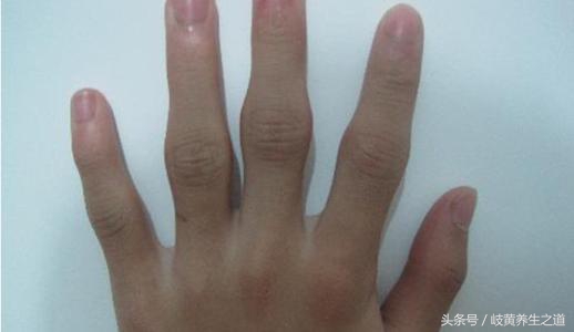 蜂疗类风湿性关节炎,蜂疗类风湿的穴位