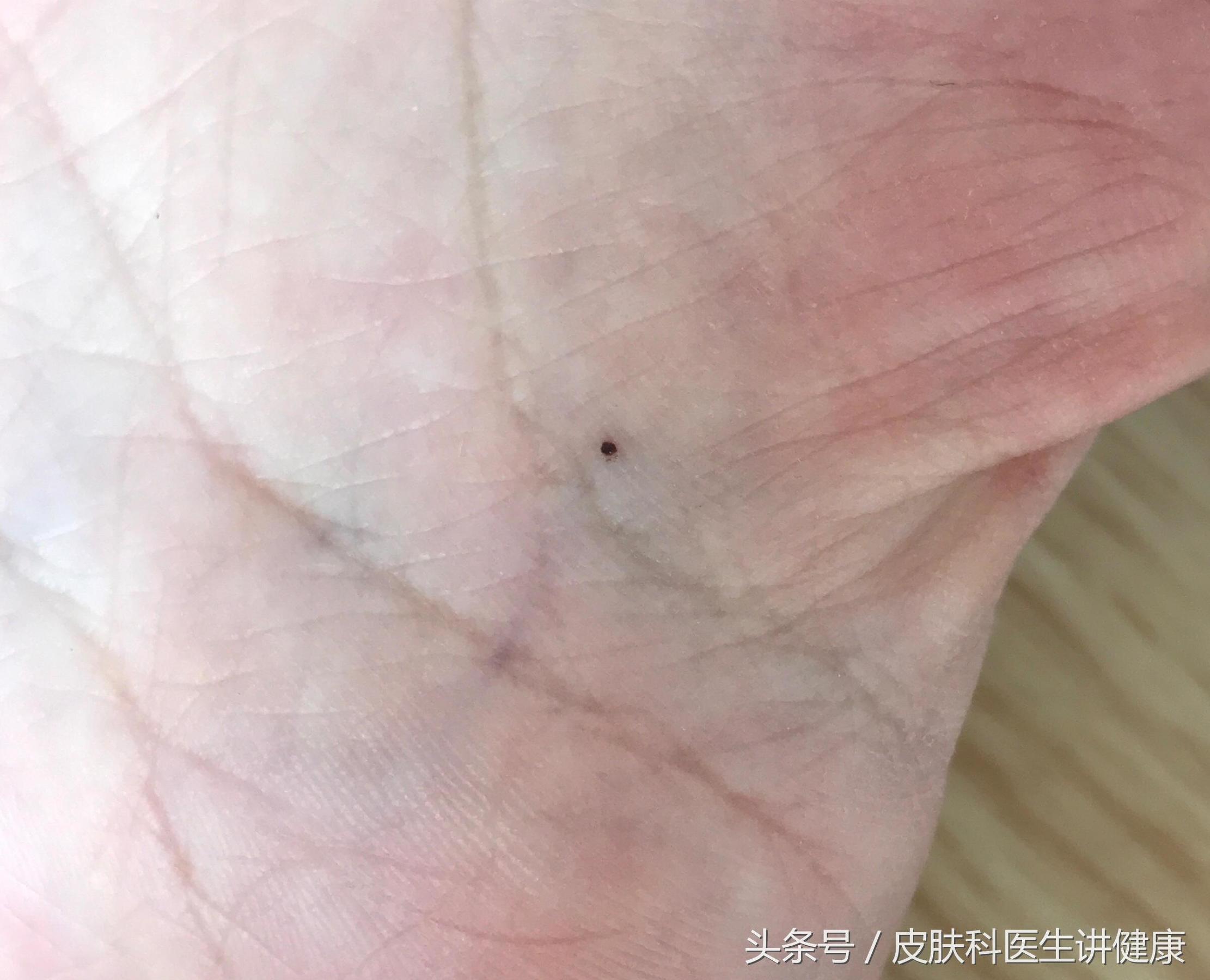 色素痣会出现大面积皮肤发黑吗,如何区分黑斑与色素痣