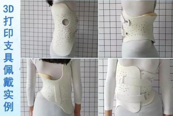 案例l3D打印支具助力青少年脊柱侧弯保守治疗