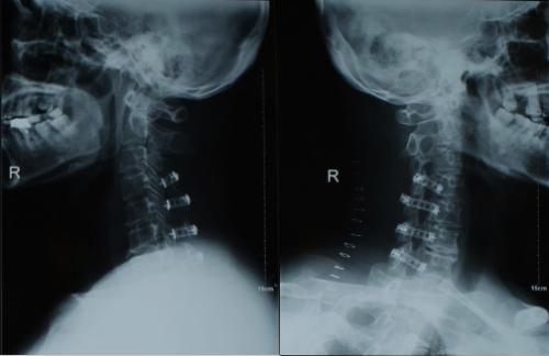 颈椎病疼痛难忍，这7种方法，总有一款适合你