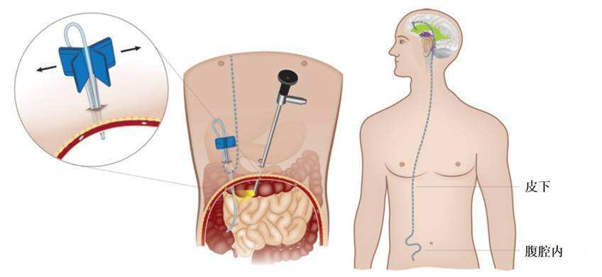 交通性脑积水腹腔分流术,脑积水手术后的病例