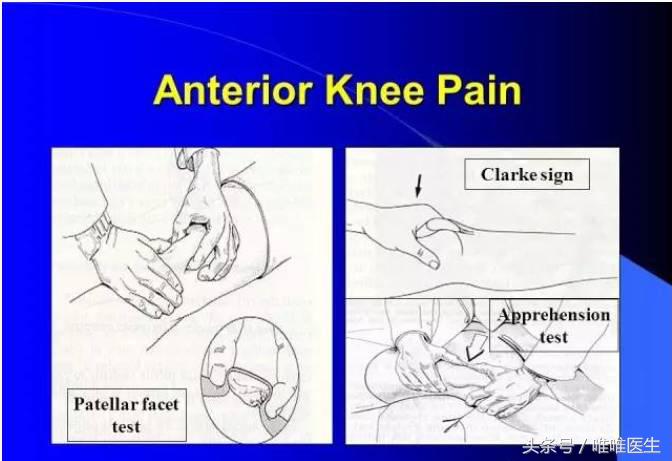 膝前左侧疼痛,膝前痛康复训练