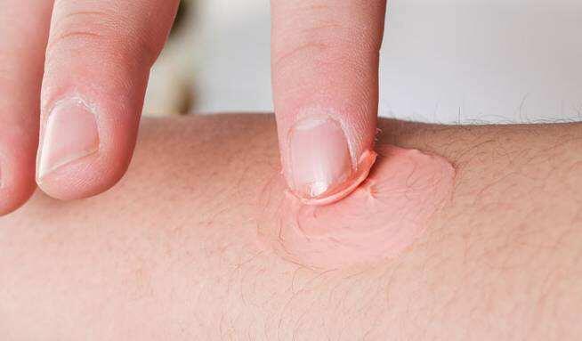 容易长湿疹教你3个方法赶走湿疹,患了湿疹怎么办教你一招简单高效