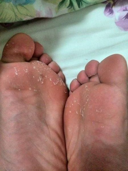 脚老是脱皮不痒脱皮后裂口子,有一只脚脱皮另一只脚不脱皮