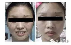 孩子吃重口味脸上斑会很明显,小孩吃什么容易脸上出现小黑点点