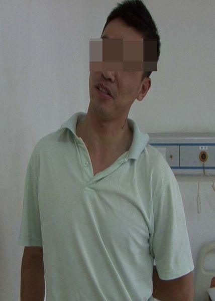 痉挛性斜颈用中医疗法可以根治,痉挛性斜颈中医理疗办法