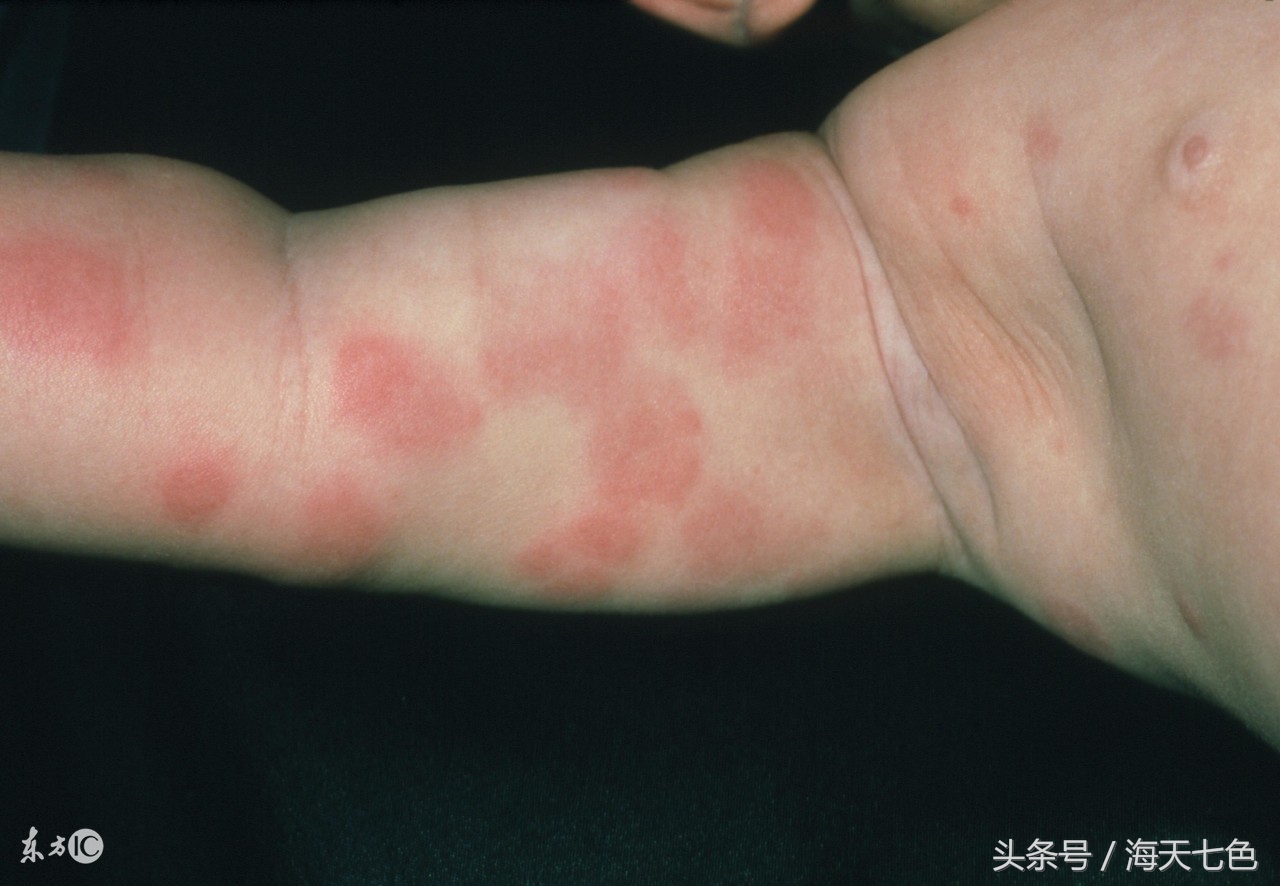 天天烤艾灸能有什么副作用,做艾灸理疗的副作用是什么