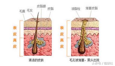 医美去黑头小妙招,医美去黑头有多少种方法