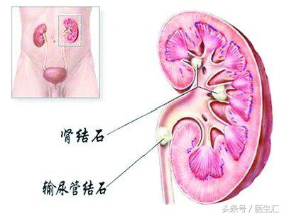 肾结石的治疗最佳方法是什么,肾结石最好的治疗方式