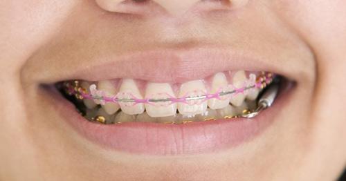 矫正牙齿过程中会出现的问题,矫正过程中牙齿出现反弹