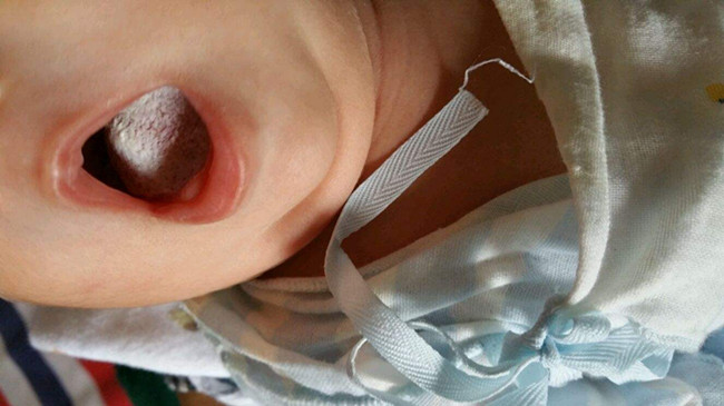 宝宝鹅口疮怎么治,宝宝得鹅口疮怎么办