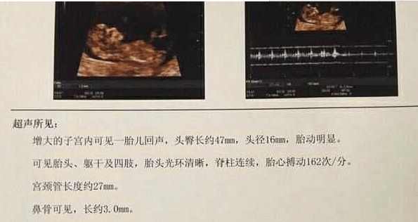 艰辛怀上双胞胎,艰辛孕育孩子