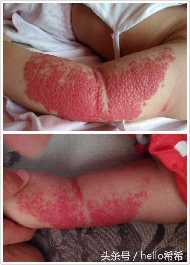 山西婴儿血管瘤最佳治疗,山西长峰血管瘤医院