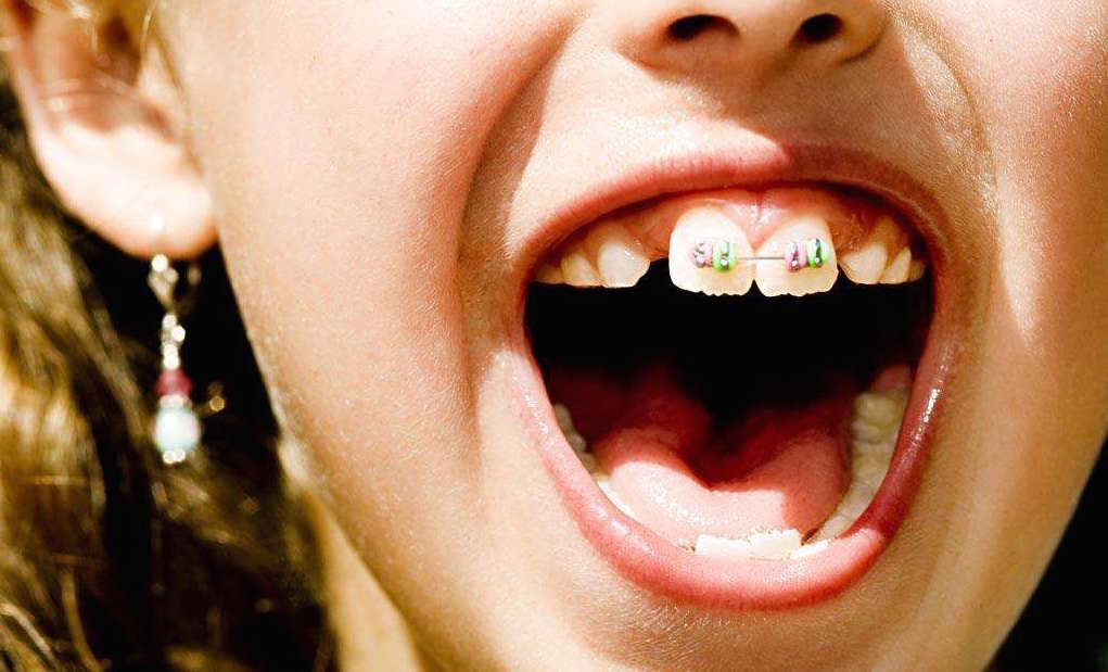 矫正牙齿过程中会出现的问题,矫正过程中牙齿出现反弹