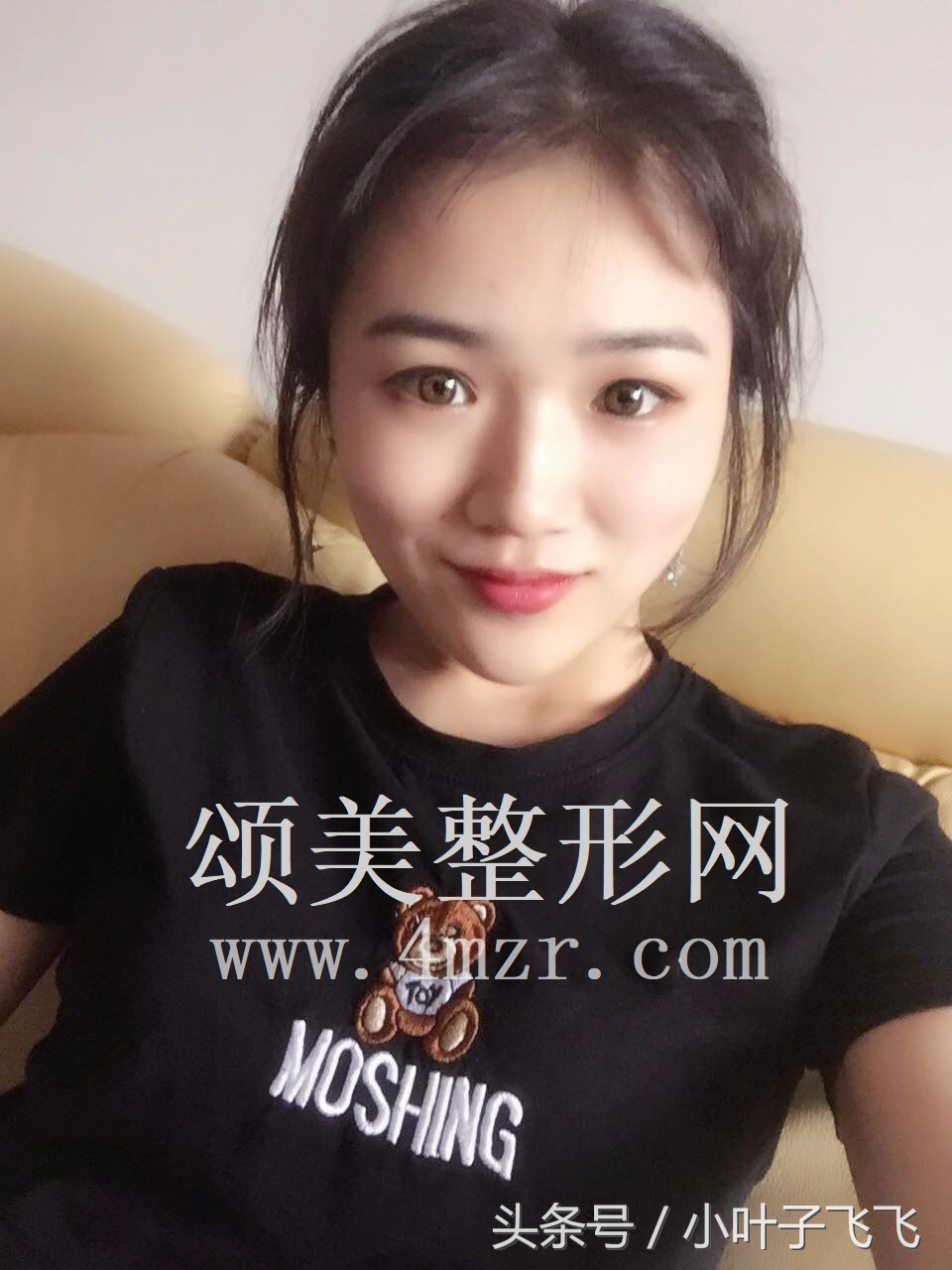 伊婉玻尿酸打面部提升效果怎么样,伊婉玻尿酸中分子打下巴会变形吗