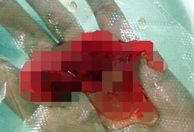 做什么检查能看出女人流产过几次,一个人可以做流产多少次