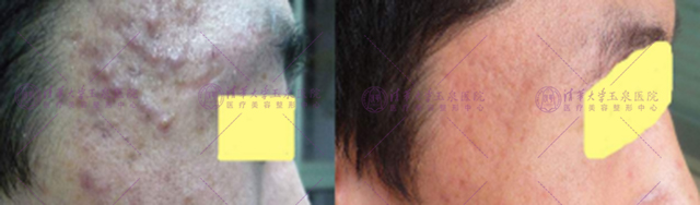 三角区痘疤的正确消除方法,专家告诉你怎么祛除脸上的痘痘