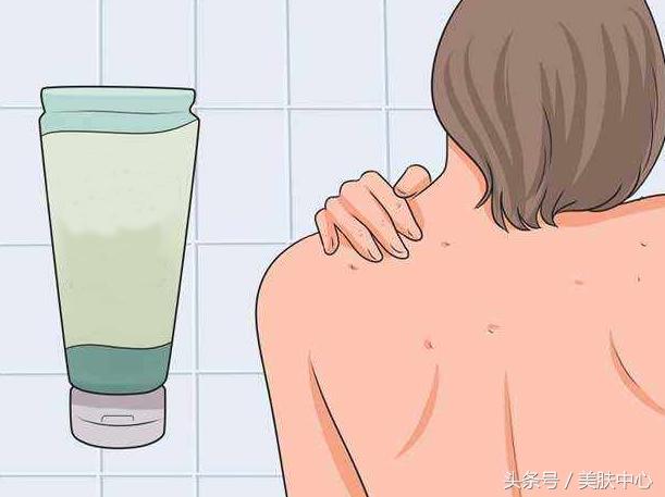 背部长了痘痘千万不要用手挤，小妙招教你轻松清除