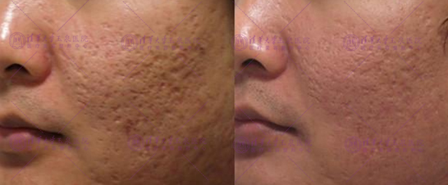 三角区痘疤的正确消除方法,专家告诉你怎么祛除脸上的痘痘