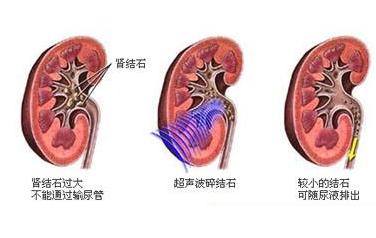 肾结石最好最安全的治疗方法,肾结石输尿管中段能体外碎结石吗