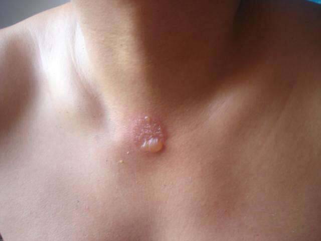 艾灰与白醋的功效与作用,艾灰不要扔了它也能治病