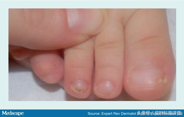 医学关于3岁小孩指甲脱落问题,儿童指甲大面积脱落图片