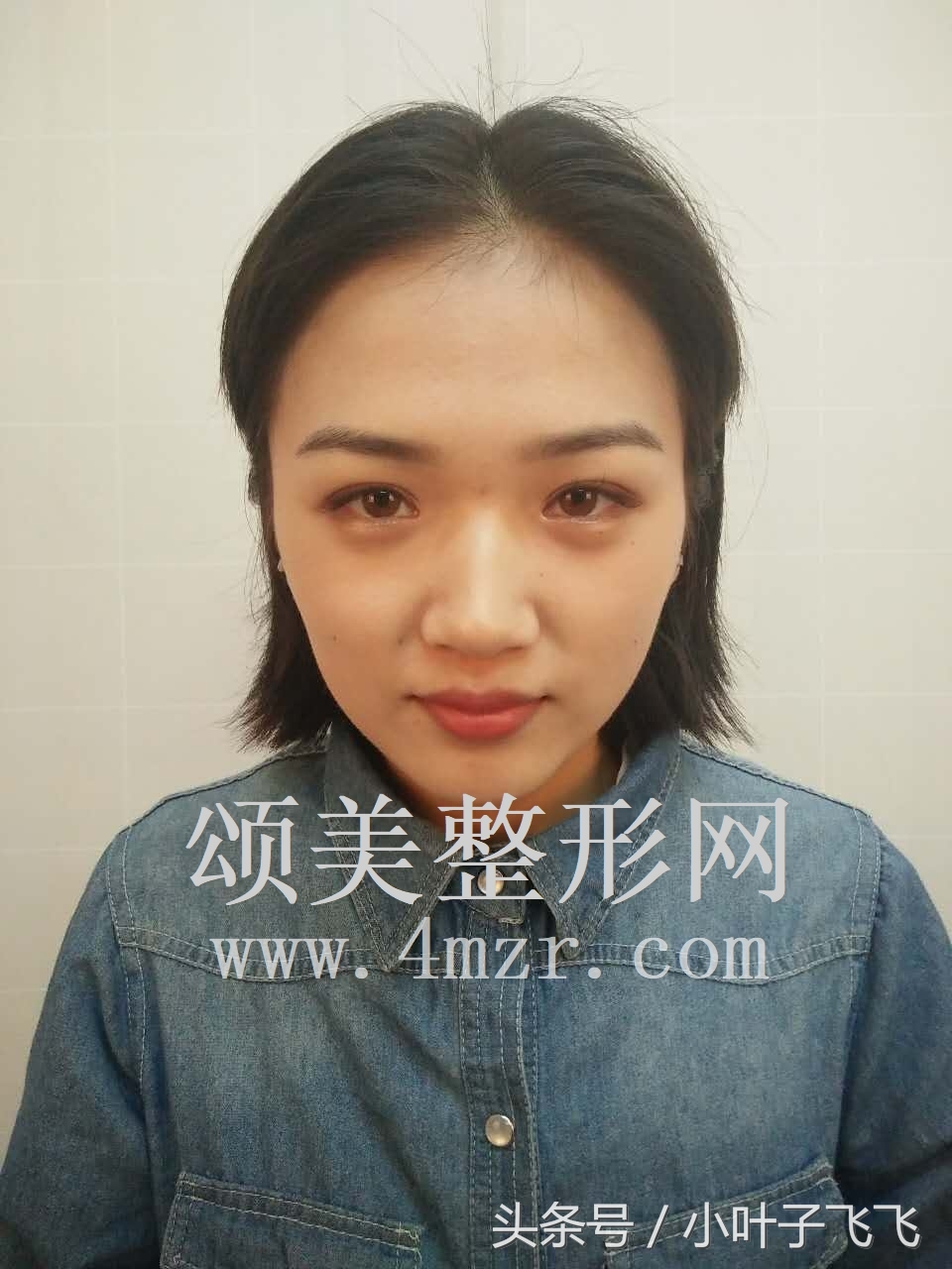 伊婉玻尿酸打面部提升效果怎么样,伊婉玻尿酸中分子打下巴会变形吗