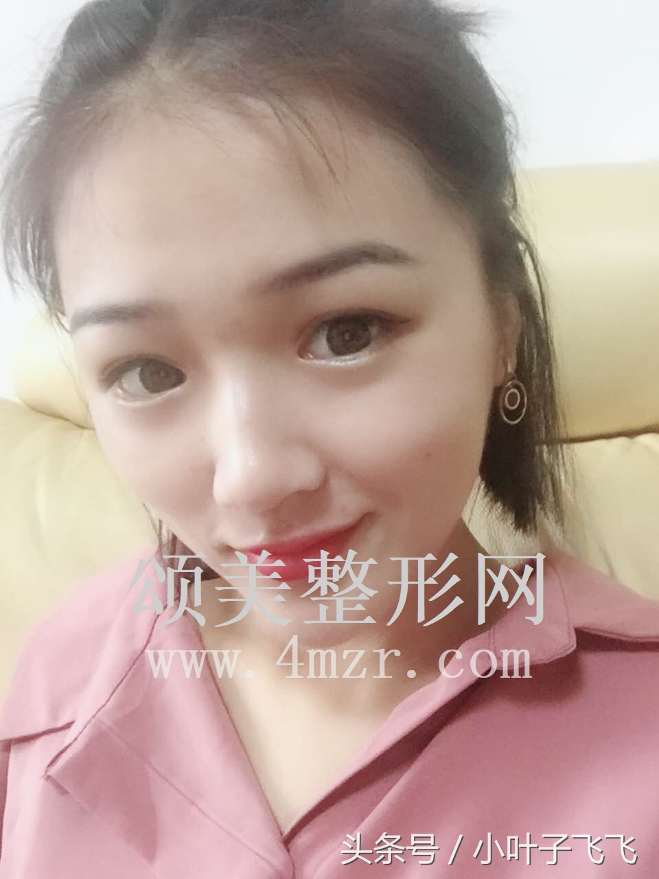 伊婉玻尿酸打面部提升效果怎么样,伊婉玻尿酸中分子打下巴会变形吗