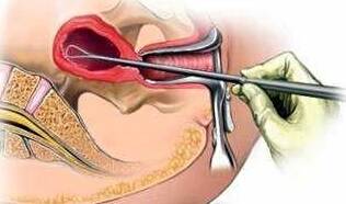 做什么检查能看出女人流产过几次,一个人可以做流产多少次