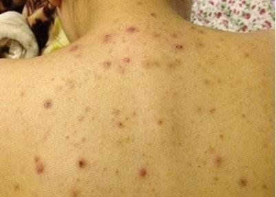 湿气重怎么办最快最有效的办法,湿气重怎么办一个小方法轻松搞定