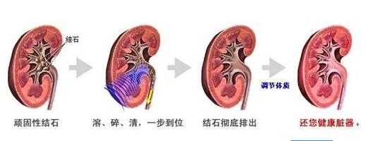 肾结石最好最安全的治疗方法,肾结石输尿管中段能体外碎结石吗