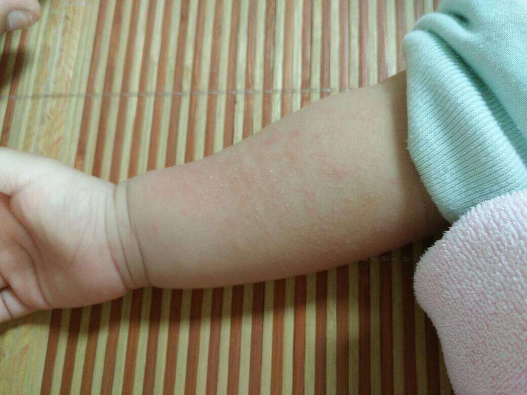 艾灰与白醋的功效与作用,艾灰不要扔了它也能治病