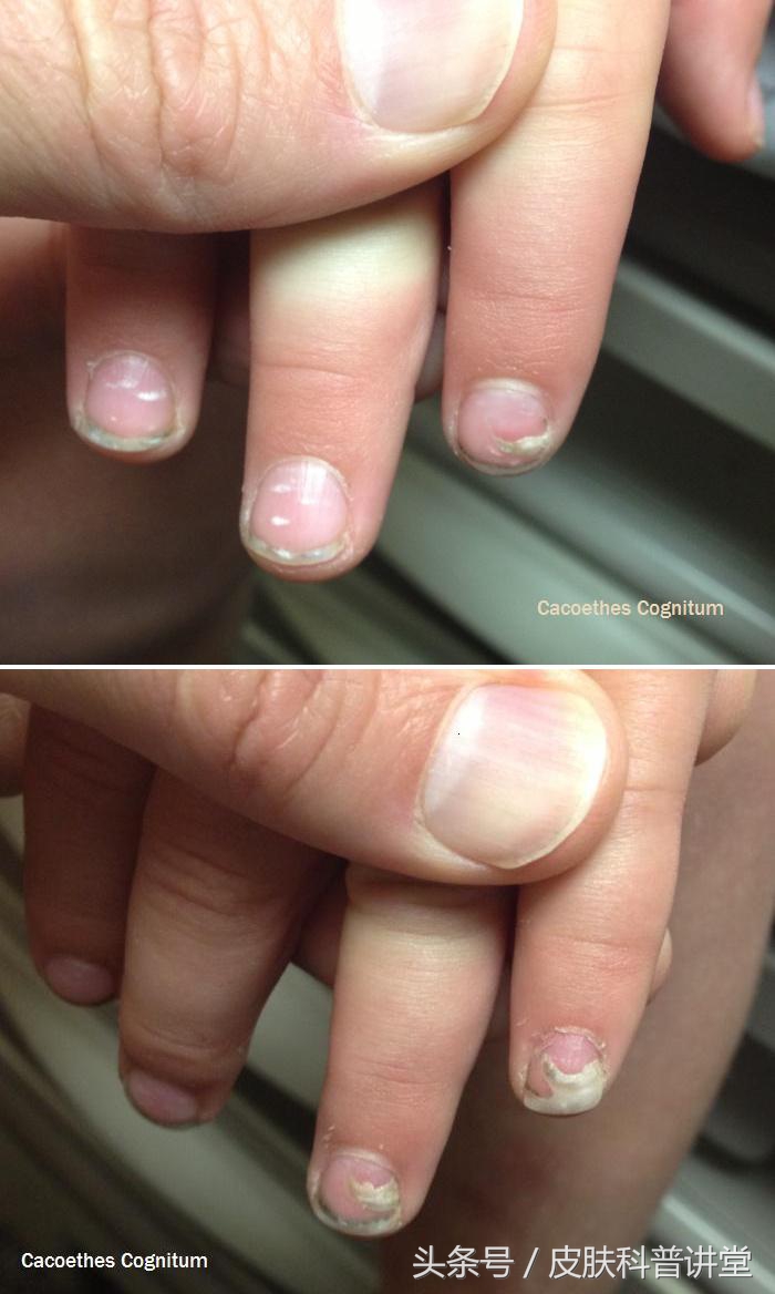 医学关于3岁小孩指甲脱落问题,儿童指甲大面积脱落图片