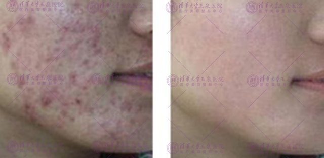 三角区痘疤的正确消除方法,专家告诉你怎么祛除脸上的痘痘