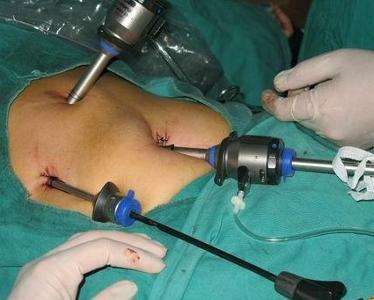 肾结石最好最安全的治疗方法,肾结石输尿管中段能体外碎结石吗