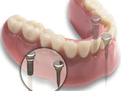 种植牙十大危害图片,种植牙的十大危害要戴牙套吗
