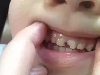 蛀牙的修补和牙齿矫正的问题,爱牙日公益讲座视频