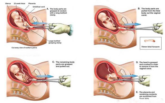 女人一生最多能承受几次生产,女人一生最多能承受几次剖宫产