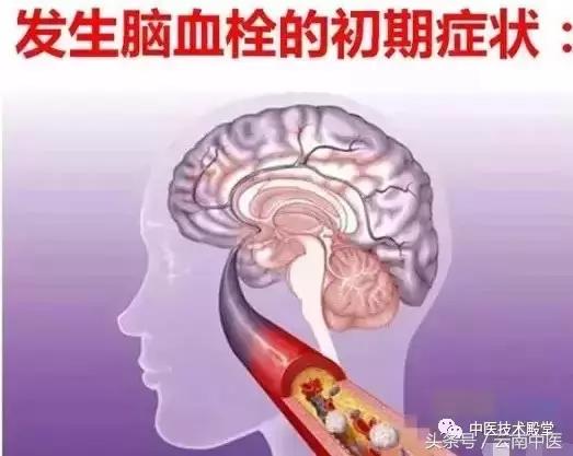 脑血栓前兆有10个表现,脑血栓有前兆当心这7个症状