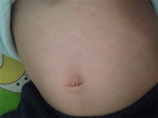 新生儿肚子有红点是怎么回事,肚子周围起红点是怎么回事