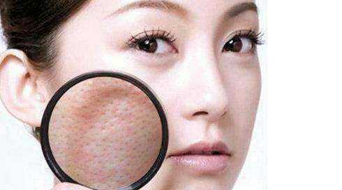 脸上毛孔里挤出白色条状是螨虫吗,脸上长螨虫的表现你中招了吗