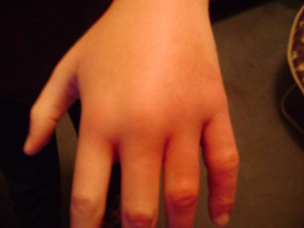 一天喝水超过8杯会水肿吗,喝一杯水就水肿