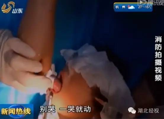 6岁宝宝喝水,不慎将舌头卡住瓶盖至血肿僵硬