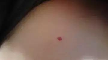 黑痣变红痣有问题吗,黑痣红痣突然变大增多是什么原因