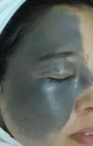 黑痣变红痣有问题吗,黑痣红痣突然变大增多是什么原因