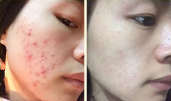 一个月解决痘痘方法,一个多月的痘痘怎么消