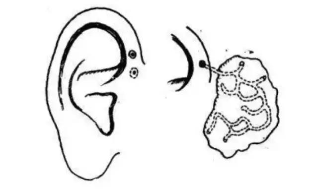 耳朵附近的小孔是什么,耳朵上有聪明嵴真的就聪明吗