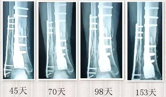 骨折多月了始终不愈合?!骨不连的危害真的有这么大?!