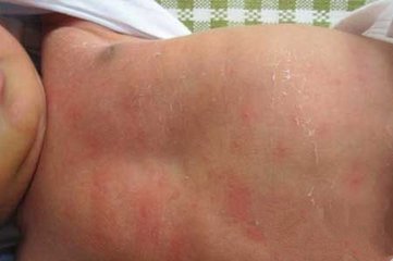 新生儿肚子有红点是怎么回事,肚子周围起红点是怎么回事